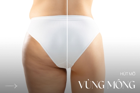 Hút mỡ vùng mông